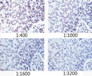 Immunohistochemistry analysis of paraffin-embedded human esophageal cancer using Anti-Lamin A Antibody [ARC5001-08] (A308800) at a dilution of 1:400 - 1:3200 (40x lens) Perform microwave antigen retrieval with 10 mM PBS buffer pH 72 before commencing with IHC staining protocol