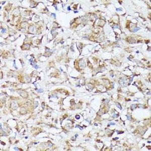 Immunohistochemistry analysis of paraffin-embedded human mammary cancer using Anti-MTHFD2 Antibody (A11302) at a dilution of 1:100 (40x lens) Perform microwave antigen retrieval with 10 mM PBS buffer pH 72 before commencing with IHC staining protocol