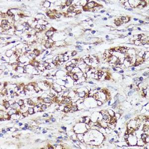 Immunohistochemistry analysis of paraffin-embedded human liver cancer using Anti-MTHFD2 Antibody (A11302) at a dilution of 1:100 (40x lens) Perform microwave antigen retrieval with 10 mM PBS buffer pH 72 before commencing with IHC staining protocol