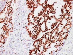 Immunohistochemical analysis of paraffin-embedded human Colon carcinoma using Anti-Ki67 Antibody