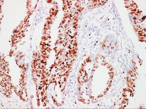 Immunohistochemical analysis of paraffin-embedded human Colon carcinoma using Anti-Ki67 Antibody