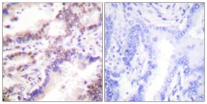 Immunohistochemical analysis of paraffin-embedded human lung carcinoma tissue using Anti-CTIP Antibody. The right hand panel represents a negative control, where the Antibody was pre-incubated with the immunising peptide