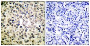 Immunohistochemical analysis of paraffin-embedded human breast carcinoma tissue using Anti-NF-kappaB p65 Antibody The right hand panel represents a negative control, where the antibody was pre-incubated with the immunising peptide