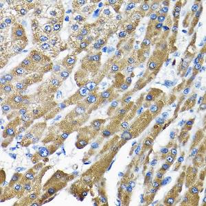 Immunohistochemistry analysis of paraffin-embedded human liver cancer using Anti-THUMPD3 Antibody (A11309) at a dilution of 1:200 (40x lens). Perform high pressure antigen retrieval with 10 mM citrate buffer pH 6.0 before commencing with IHC staining protocol.