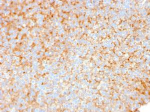 Immunohistochemical analysis of formalin-fixed, paraffin-embedded human urothelial carcinoma using Anti-SERBP1 Antibody [SERBP1/3491]