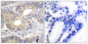 Immunohistochemical analysis of paraffin-embedded human colon carcinoma tissue using Anti-Somatostatin Antibody. The right hand panel represents a negative control, where the antibody was pre-incubated with the immunising peptide