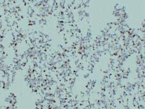 Immunohistochemical analysis of paraffin-embedded human Malignant fibrous histiocytoma using Anti-CD68 Antibody