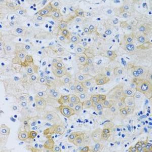 Immunohistochemistry analysis of paraffin-embedded human liver using Anti-SLC4A5 Antibody (A11313) at a dilution of 1:100 (40x lens). Perform microwave antigen retrieval with 10 mM PBS buffer pH 7.2 before commencing with IHC staining protocol.