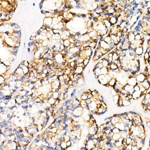 Immunohistochemistry analysis of paraffin-embedded human thyroid cancer using Anti-PGP9