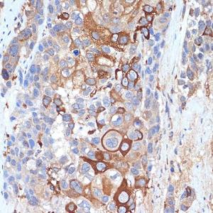 Immunohistochemistry analysis of paraffin-embedded human esophageal cancer using Anti-SIGLEC15 Antibody (A305933) at a dilution of 1:100 (40X lens). Perform microwave antigen retrieval with 10 mM Tris/EDTA buffer pH 9.0 before commencing with IHC staining protocol