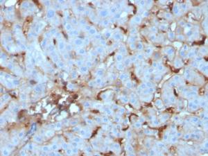 Immunohistochemical analysis of formalin-fixed, paraffin-embedded human renal cell carcinoma using Anti-C1QA Antibody [C1QA/2955]