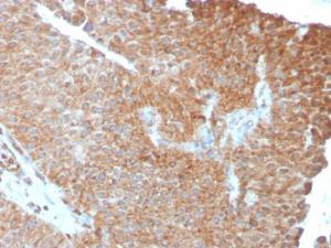 Immunohistochemical analysis of formalin-fixed, paraffin-embedded human urothelial carcinoma using Anti-SERBP1 Antibody [SERBP1/3493]