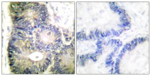 Immunohistochemical analysis of paraffin-embedded human colon carcinoma tissue using Anti-Cytochrome c Antibody. The right hand panel represents a negative control, where the antibody was pre-incubated with the immunising peptide.