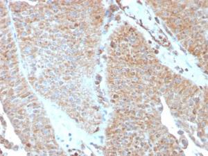 Immunohistochemical analysis of formalin-fixed, paraffin-embedded human urothelial carcinoma using Anti-SERBP1 Antibody [SERBP1/3493]