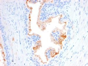 Immunohistochemical analysis of formalin-fixed, paraffin-embedded human prostate carcinoma using Anti-CD10 Antibody [MME/2580]