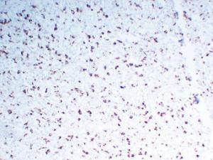 Immunohistochemical analysis of paraffin-embedded human Malignant fibrous histiocytoma using Anti-CD68 Antibody