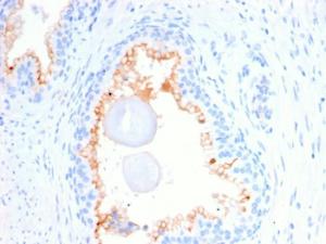 Immunohistochemical analysis of formalin-fixed, paraffin-embedded human prostate carcinoma using Anti-CD10 Antibody [MME/2580]