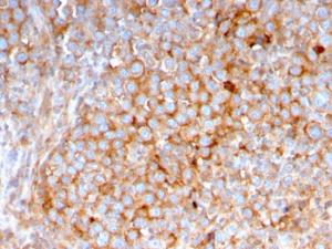 Immunohistochemical analysis of formalin-fixed, paraffin-embedded human urothelial carcinoma using Anti-SERBP1 Antibody [SERBP1/3495]