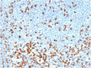 Immunohistochemical analysis of formalin-fixed, paraffin-embedded human lymphoma using Anti-ZAP70 Antibody [rZAP70/2046]