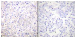 Immunohistochemical analysis of paraffin-embedded human breast carcinoma tissue using Anti-Cadherin-pan Antibody. The right hand panel represents a negative control, where the Antibody was pre-incubated with the immunising peptide