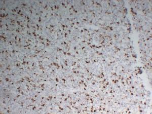 Immunohistochemical analysis of paraffin-embedded human Malignant fibrous histiocytoma using Anti-CD68 Antibody