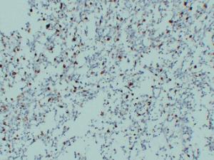 Immunohistochemical analysis of paraffin-embedded human Malignant fibrous histiocytoma using Anti-CD68 Antibody