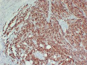 Immunohistochemical analysis of paraffin-embedded human Malignant melanoma using Anti-CD63 Antibody