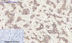 Immunohistochemical analysis of paraffin-embedded human liver cancer tissue using Anti-Cadherin-pan Antibody at 1:200 (4 °C overnight). Negative control was secondary Antibody only