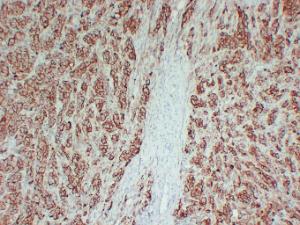 Immunohistochemical analysis of paraffin-embedded human Malignant melanoma using Anti-CD63 Antibody