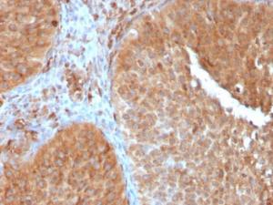 Immunohistochemical analysis of formalin-fixed, paraffin-embedded human urothelial carcinoma using Anti-SERBP1 Antibody [SERBP1/3497]