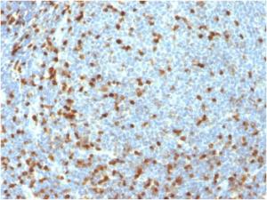 Immunohistochemical analysis of formalin-fixed, paraffin-embedded human lymphoma using Anti-ZAP70 Antibody [ZAP70/3921R]