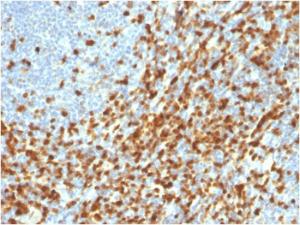 Immunohistochemical analysis of formalin-fixed, paraffin-embedded human lymphoma using Anti-ZAP70 Antibody [ZAP70/3921R]