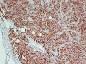 Immunohistochemical analysis of paraffin-embedded human Malignant melanoma using Anti-CD63 Antibody