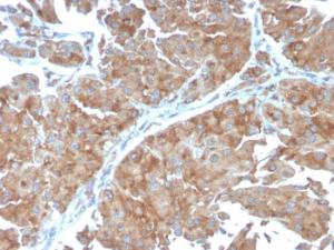 Immunohistochemical analysis of formalin-fixed, paraffin-embedded human urothelial carcinoma using Anti-SERBP1 Antibody [SERBP1/3498]