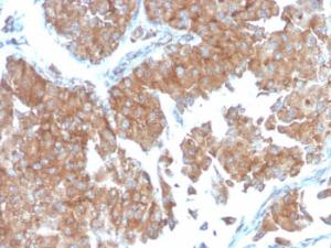 Immunohistochemical analysis of formalin-fixed, paraffin-embedded human urothelial carcinoma using Anti-SERBP1 Antibody [SERBP1/3498]