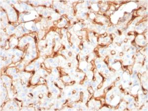 Immunohistochemical analysis of formalin-fixed, paraffin-embedded human hepatocellular carcinoma using Anti-C1QB Antibody [C1QB/2965]