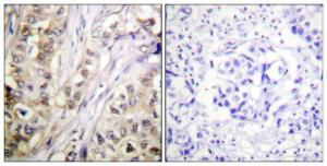 Immunohistochemical analysis of paraffin-embedded human breast carcinoma tissue using Anti-Survivin Antibody. The right hand panel represents a negative control, where the antibody was pre-incubated with the immunising peptide