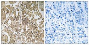 Immunohistochemical analysis of paraffin-embedded human breast carcinoma tissue using Anti-BUB1 Antibody The right hand panel represents a negative control, where the antibody was pre-incubated with the immunising peptide