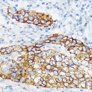 Immunohistochemistry analysis of paraffin-embedded human esophageal cancer using Anti-Collagen XVII Antibody [ARC0233] (A308839) at a dilution of 1:100 (40x lens). Perform microwave antigen retrieval with 10 mM Tris/EDTA buffer pH 9.0 before commencing with IHC staining protocol.