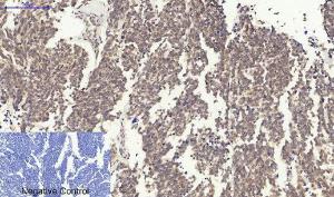 Immunohistochemical analysis of paraffin-embedded human lung cancer tissue using Anti-Survivin Antibody at 1:200 (4°C overnight). Negative control was secondary antibody only