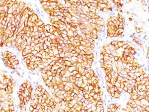 Immunohistochemical analysis of formalin-fixed, paraffin-embedded human renal cell carcinoma using Anti-Carbonic Anhydrase IX Antibody [66.4.C2]