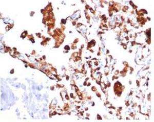 Immunohistochemical analysis of formalin-fixed, paraffin-embedded human lung adenocarcinoma tissue using Anti-NAPSIN A Antibody [rNAPSA/6926]