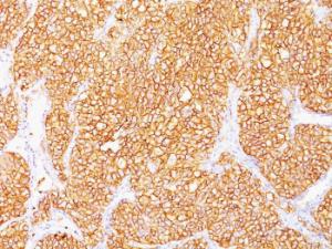 Immunohistochemical analysis of formalin-fixed, paraffin-embedded human renal cell carcinoma using Anti-Carbonic Anhydrase IX Antibody [SPM314]