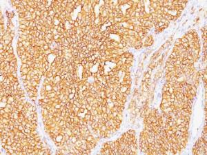 Immunohistochemical analysis of formalin-fixed, paraffin-embedded human renal cell carcinoma using Anti-Carbonic Anhydrase IX Antibody [SPM487]