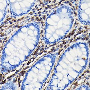 Immunohistochemistry analysis of paraffin-embedded human colon tissue using Anti-Vimentin Antibody (A308844) at a dilution of 1:100 (40X lens). Perform high pressure antigen retrieval with 10 mM citrate buffer pH 6.0 before commencing with IHC staining protocol