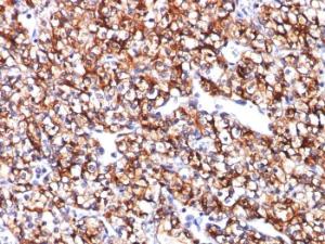 Immunohistochemical analysis of formalin-fixed, paraffin-embedded human renal cell carcinoma using Anti-Carbonic Anhydrase IX Antibody [CA9/781]