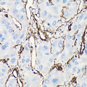 Immunohistochemistry analysis of paraffin-embedded human liver cancer using Anti-Vimentin Antibody (A308844) at a dilution of 1:100 (40X lens). Perform high pressure antigen retrieval with 10 mM citrate buffer pH 6.0 before commencing with IHC staining protocol