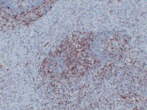 Immunohistochemical analysis of paraffin-embedded human Anaplastic large cell lymphoma using Anti-CD43 Antibody