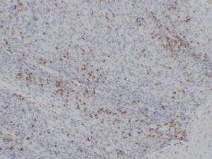 Immunohistochemical analysis of paraffin-embedded human Ovarian carcinoma using Anti-CD43 Antibody