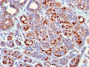 Immunohistochemical analysis of formalin-fixed, paraffin-embedded human breast carcinoma using Anti-GATA3 Antibody [GATA3/2442]